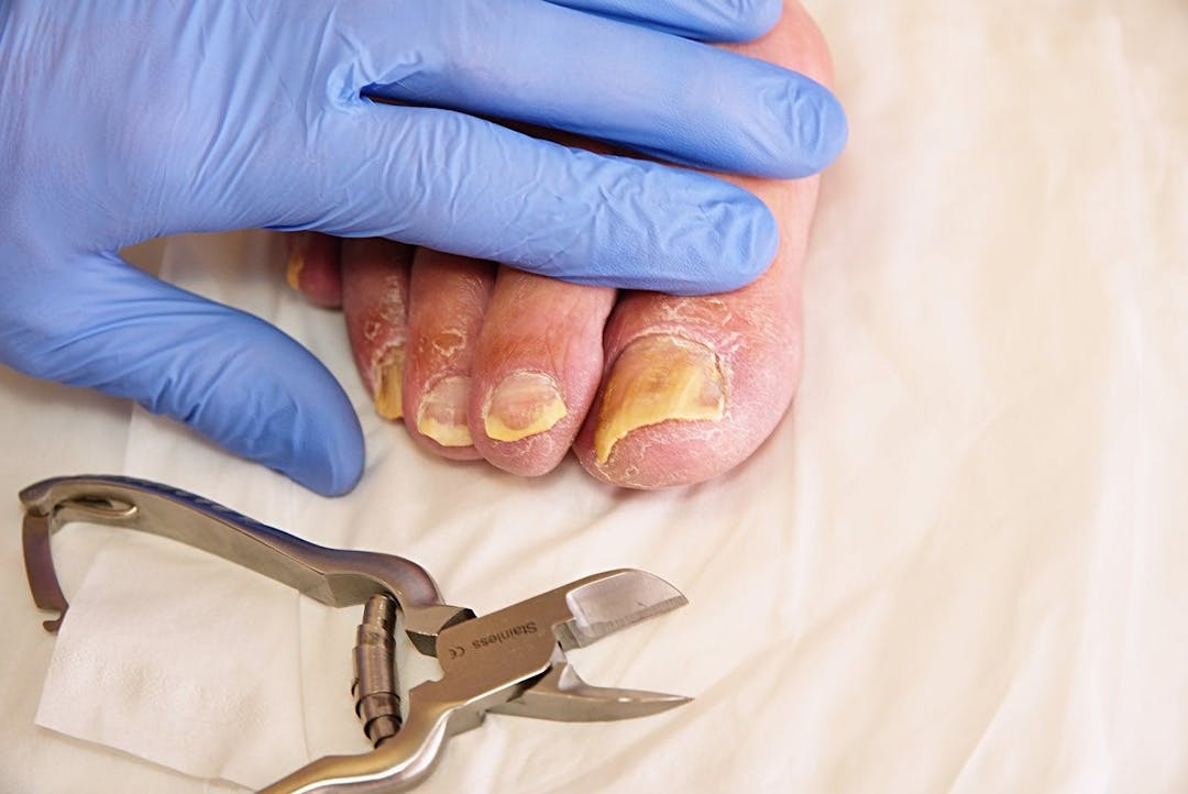 Fungus on the toes nails. Twisted toes on the foot with calluses.  Hallux rigidus tends to affect males foot.
