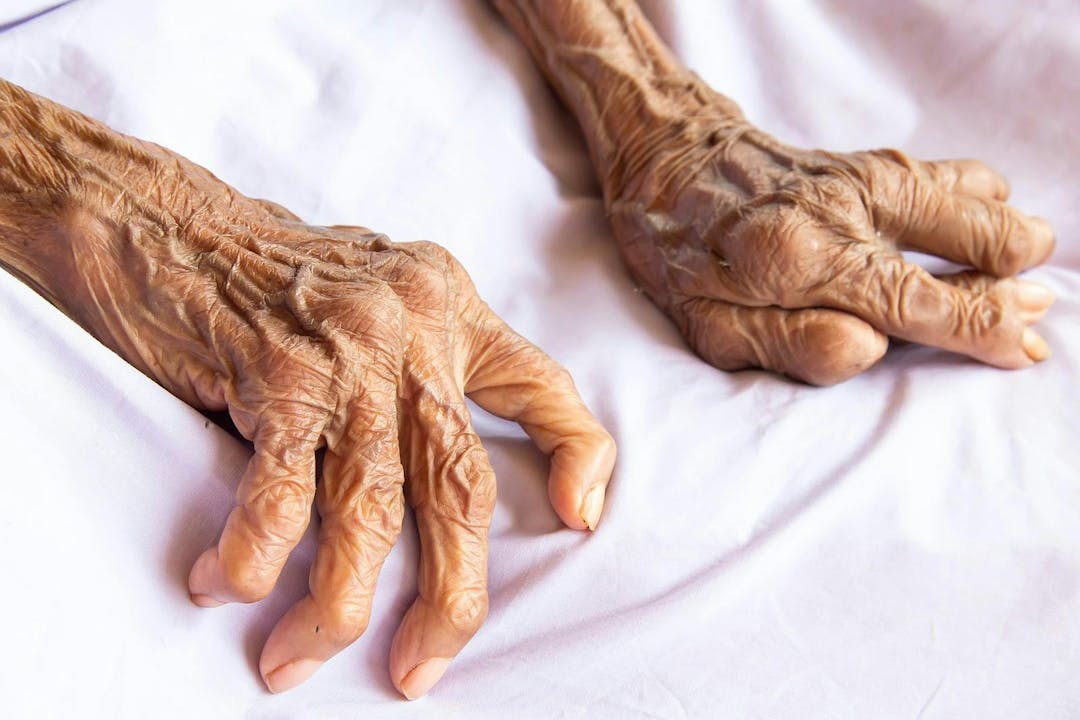 The hands of an old woman with rheumatoid arthritis. Diseases caused by degeneration of the joints of the fingers.
