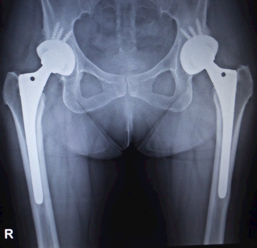 X-ray scan image of hip joints with orthopedic hip joint replacement implant head and screws in human skeleton in blue gray tones. Scanned in orthopedics traumatology surgery hospital clinic.
