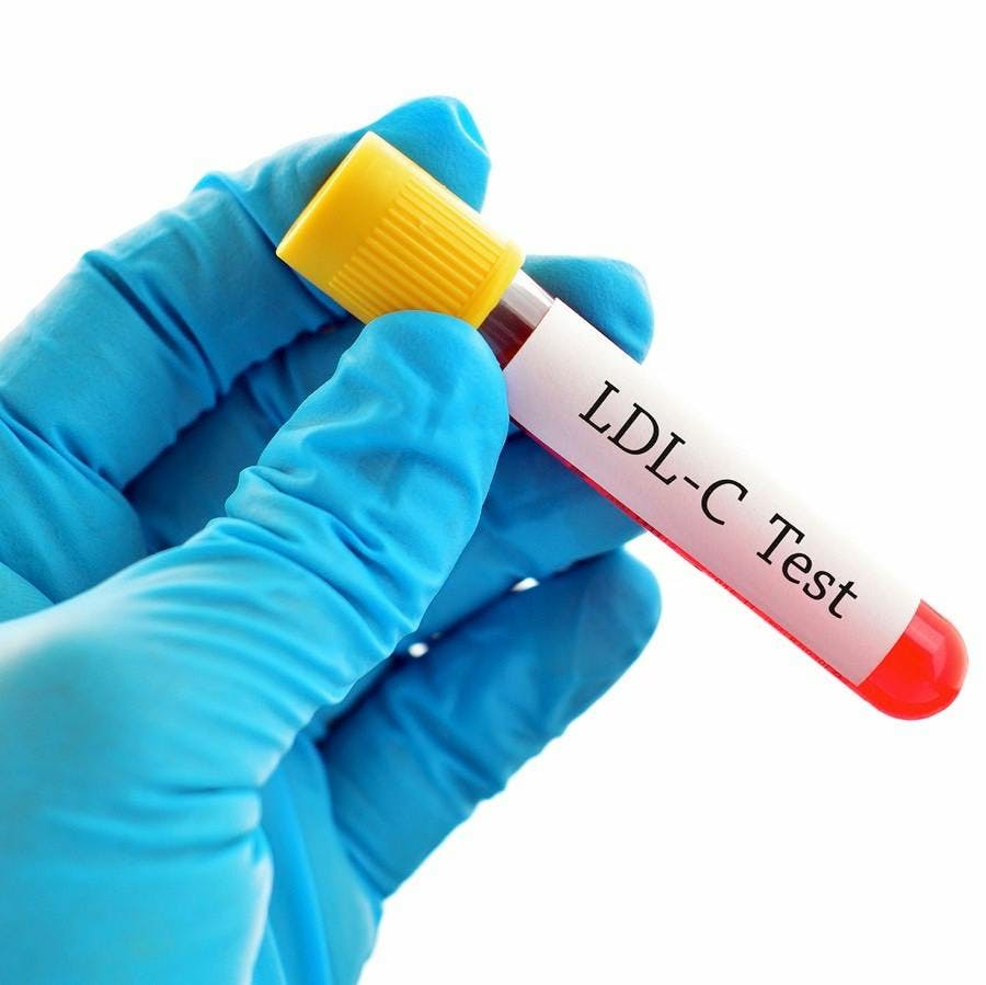 Test tube with blood sample for LDL-Cholesterol (LDL-C) test
