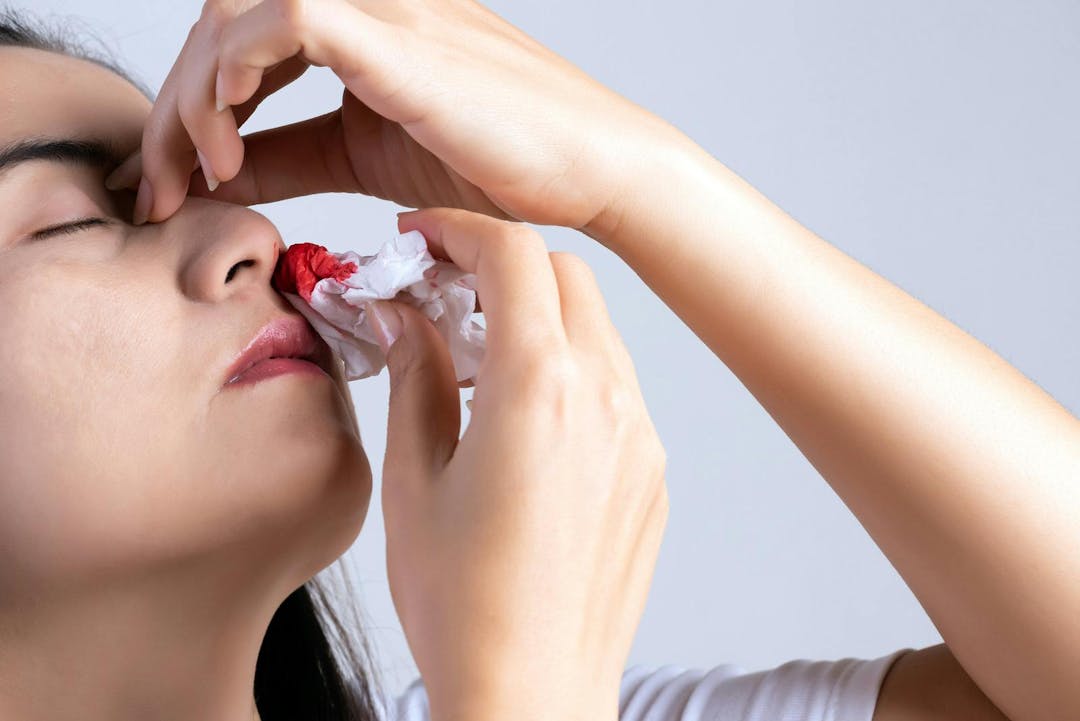 Nosebleed , a young woman with a bloody nose. Healthcare and medical concept.
