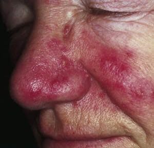 Photo by M. Sand, D. Sand, C. Thrandorf, V. Paech, P. Altmeyer, F. G. Bechara
Original file location http://de.wikipedia.org/wiki/Datei:Rosacea_01.jpg
CC 2.0 This photo has been cropped
