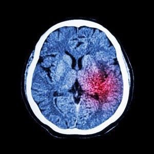 CT scan of brain show Ischemic Stroke or Hemorrhagic Stroke
