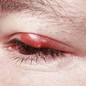 Sore Red Eye. Chalazion and Blepharitis. Inflammation
