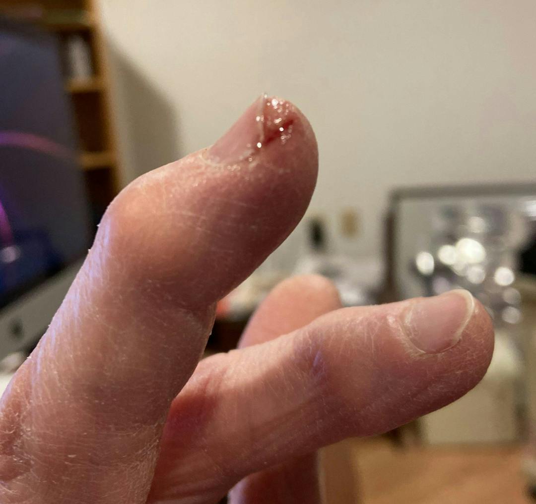 Eczema on fingertips with one split covered in instant glue
