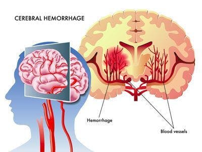 Medical illustration of the effects of the cerebral hemorrhage
