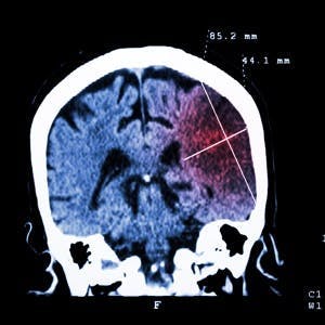 Cerebral infarction at left hemisphere ( Ischemic stroke ) ( CT-scan of brain ) : Medicine and Science background
