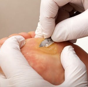 A chiropodist taking care of woman&#8217;s foot &#8211; remove skin on a wart with a scalpel on the sole of Foot of a woman
