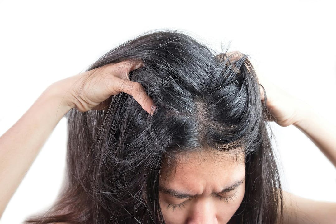 Women head with dandruff Caused by the problem of dirty. Or caused by skin disease or Seborrheic Dermatitis. It has white scaly and it will cause itch.
