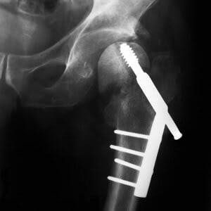 Broken bone hip fracture break
