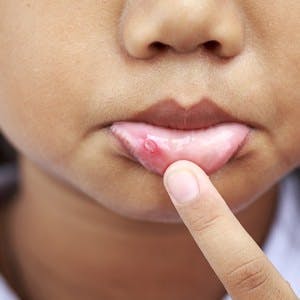 Close up Children with aphtha on lip

