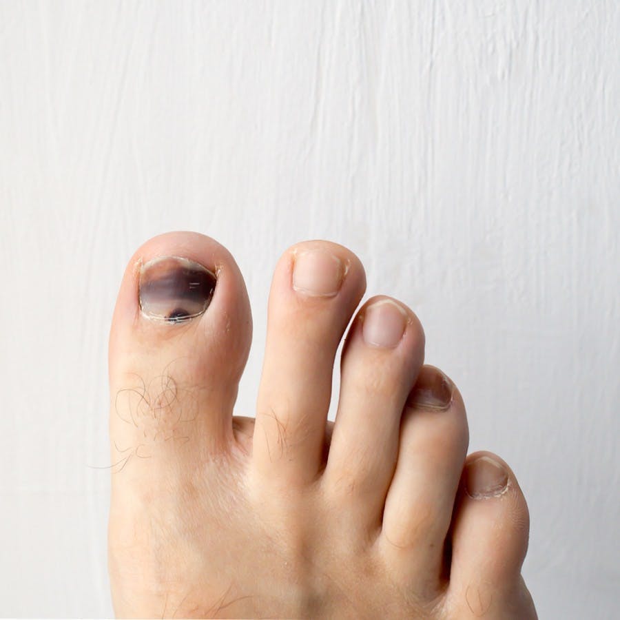Bruised nail foot on white background .
