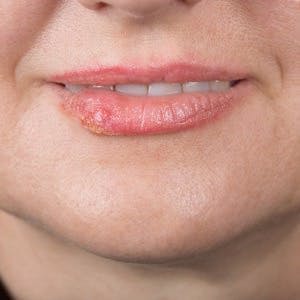 Lip infection with the herpes simplex virus
