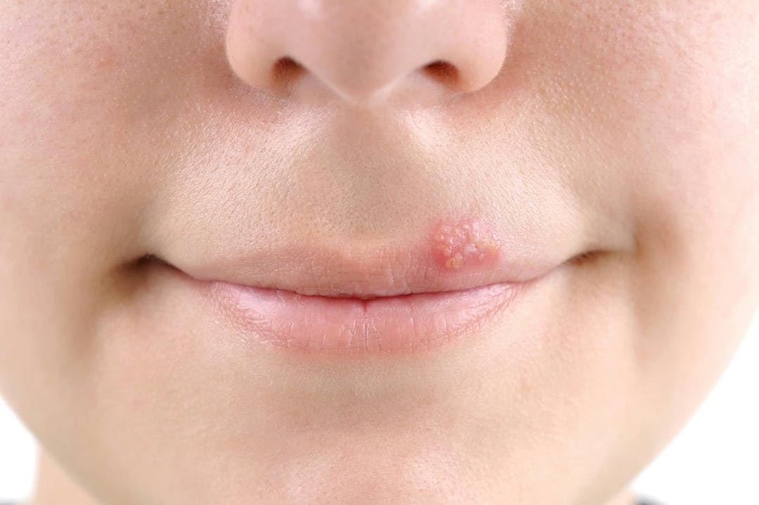 Closeup of a  common cold sore virus herpes.
