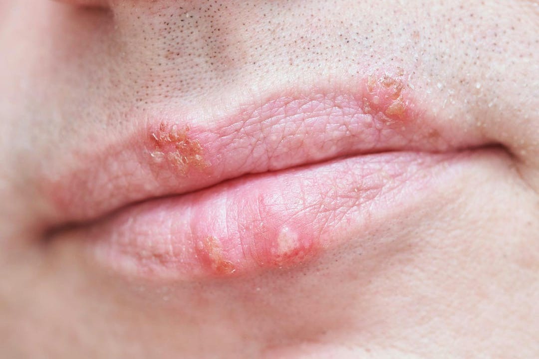 Herpes simplex virus infection on male face lips
