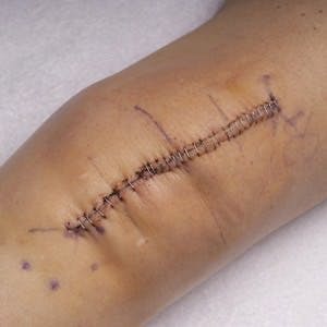 Metal staples used to stitch up skin in a replacement knee surgery operation
