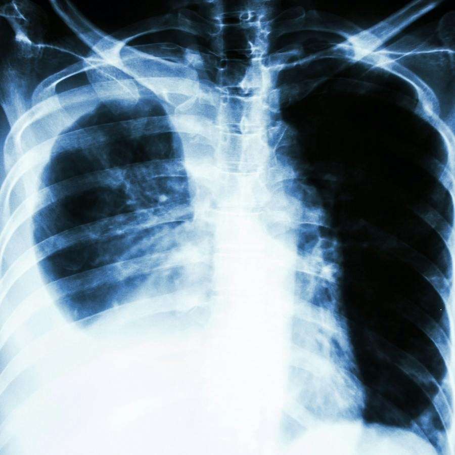 Film chest X-ray PA upright : show pleural effusion at right lung due to lung cancer

