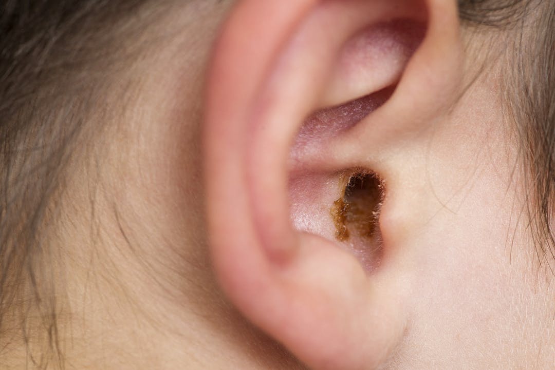 Earwax in the dirty ear of a child. Hole ear of human, wax on hair and skin of ear.
