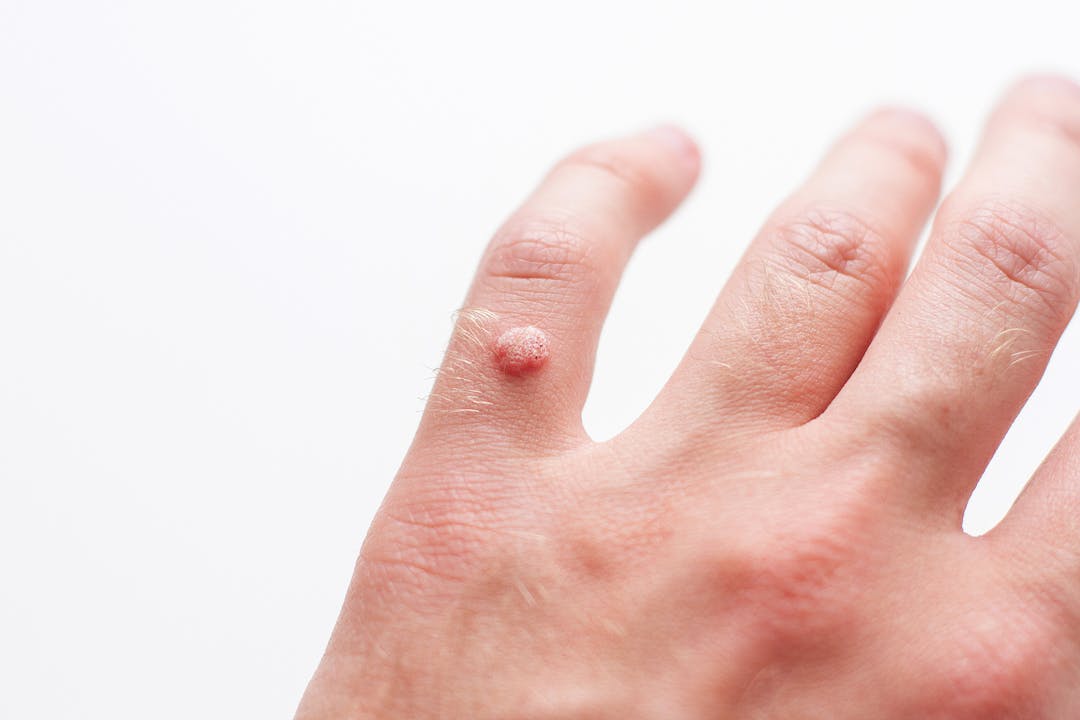 Closeup of finger wart isolated on white background. Skin diseases. Viral wart on hand.
